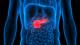 Pancreatic cancer