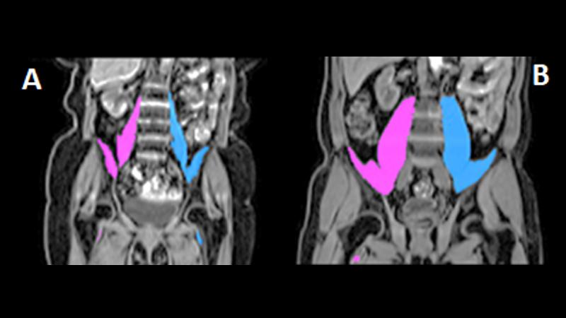 MRI images from two volunteers of the upper body highlighting the iliopsoas muscles