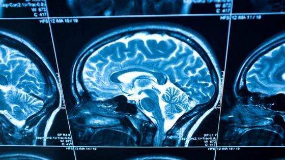 MRI scan of a brain
